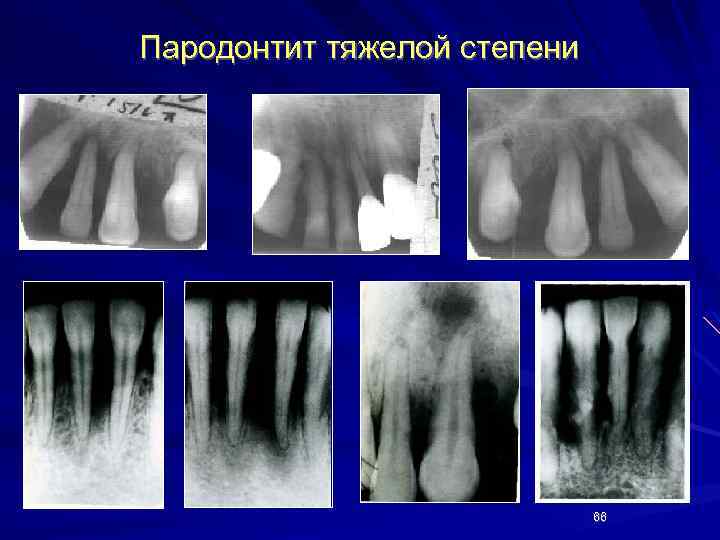 Рентгенологическая картина пародонтоз
