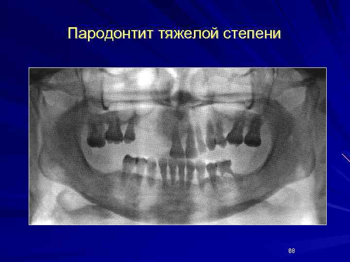 Пародонтит тяжелой степени 68 