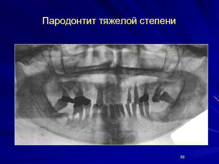 Пародонтит тяжелой степени 69 