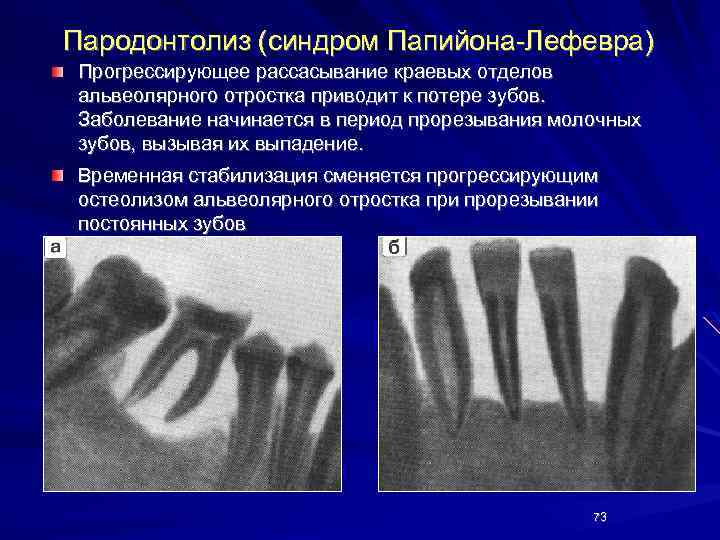 Пародонтолиз (синдром Папийона-Лефевра) Прогрессирующее рассасывание краевых отделов альвеолярного отростка приводит к потере зубов. Заболевание