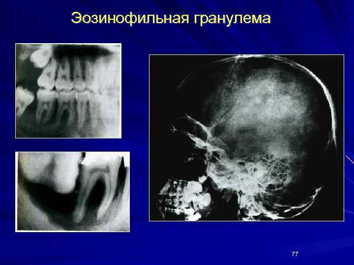 Эозинофильная гранулема 77 