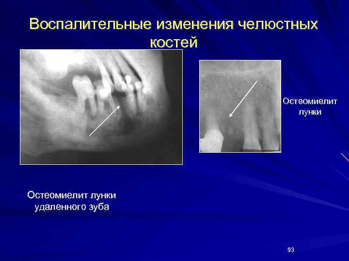 Воспалительные изменения челюстных костей Остеомиелит лунки удаленного зуба 93 