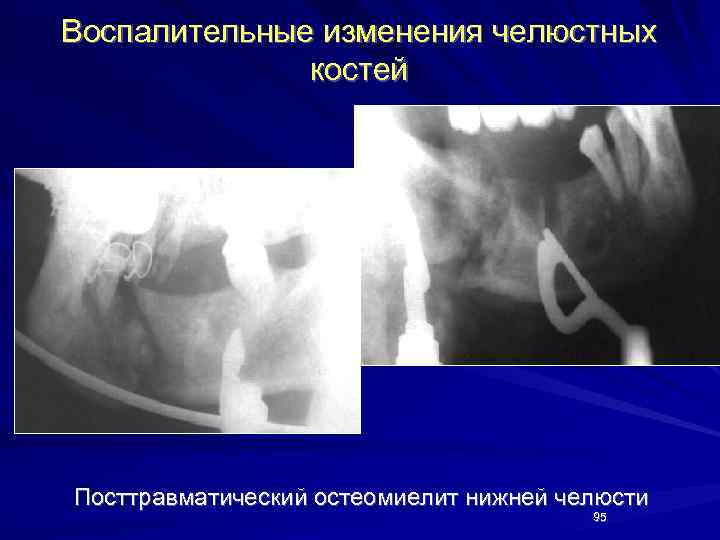 Воспалительные изменения челюстных костей Посттравматический остеомиелит нижней челюсти 95 