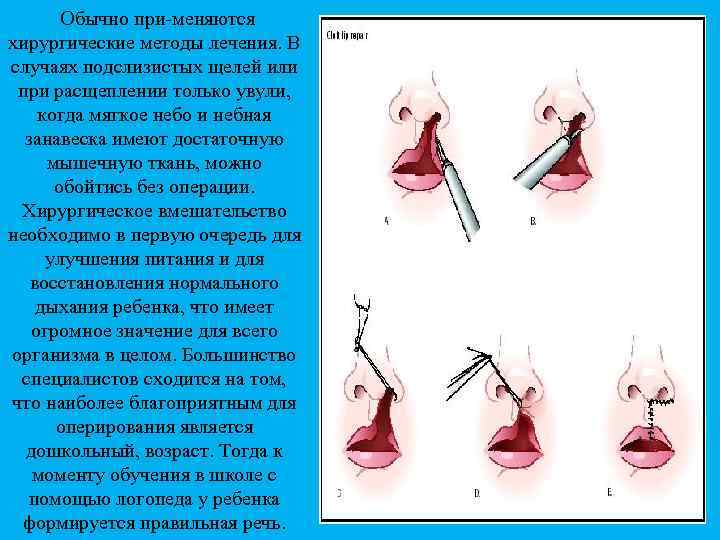 Обычно при меняются хирургические методы лечения. В случаях подслизистых щелей или при расщеплении только