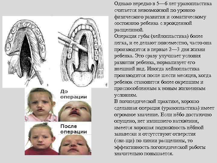 Однако нередко в 5— 6 лет уранопластика считается невозможной по уровню физического развития и