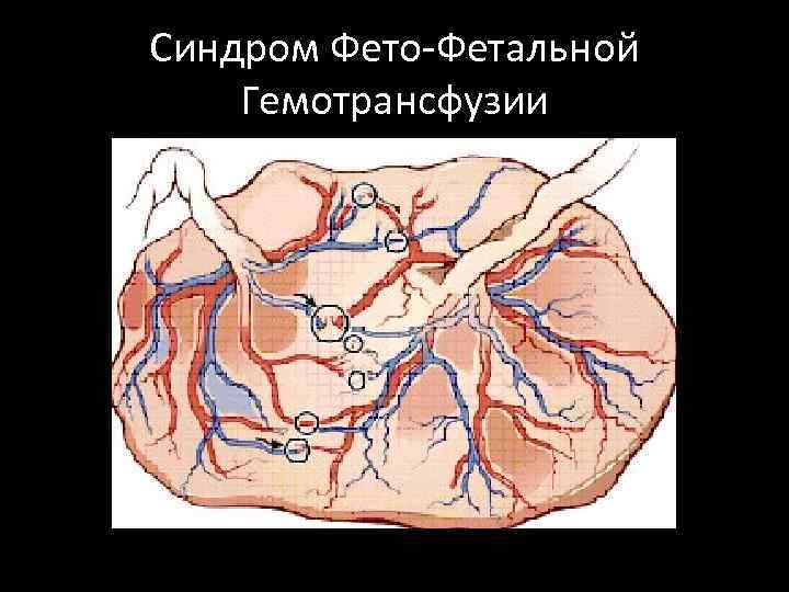 Фето фетальный трансфузионный синдром. Фетальный трансфузионный синдром. Синдром фето-фетальной гемотрансфузии. Синдром фетофатальной трансфузии это. Синдром фетоплацентарной трансфузии.