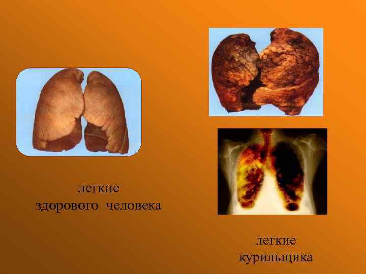 легкие здорового человека легкие курильщика 