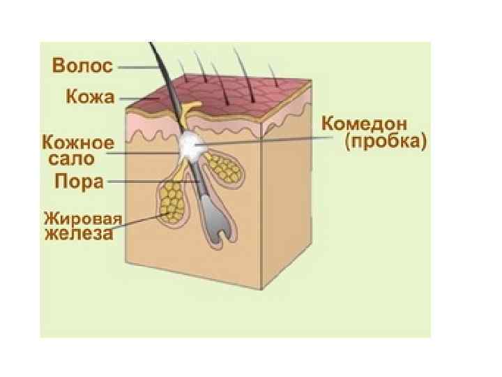 Рисунок сальной железы. Комедоны строение кожи. Угри чёрные точки строение.