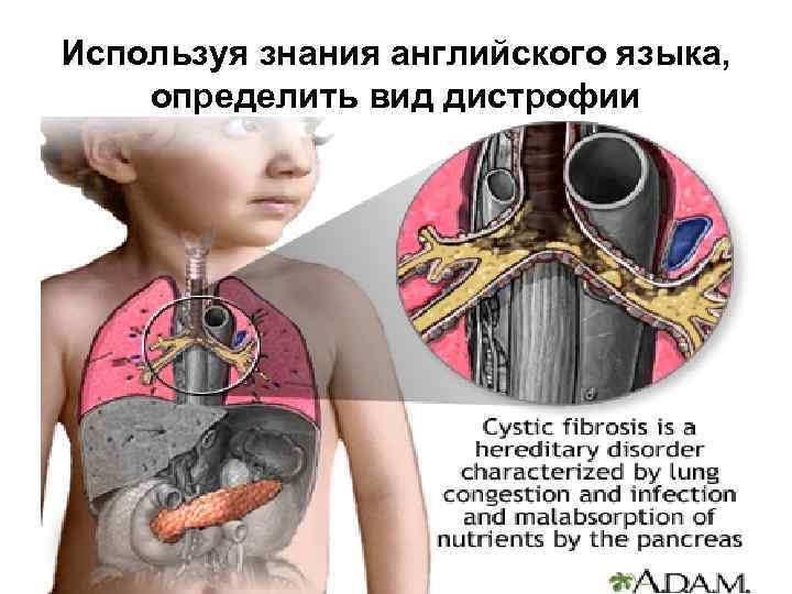 Используя знания английского языка, определить вид дистрофии 