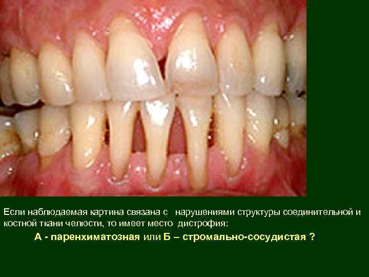 Если наблюдаемая картина связана с нарушениями структуры соединительной и костной ткани челюсти, то имеет