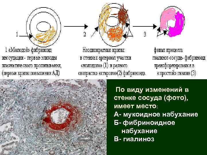По виду изменений в стенке сосуда (фото), имеет место: А- мукоидное набухание Б- фибриноидное