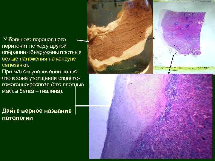 У больного перенесшего перитонит по ходу другой операции обнаружены плотные белые наложения на капсуле