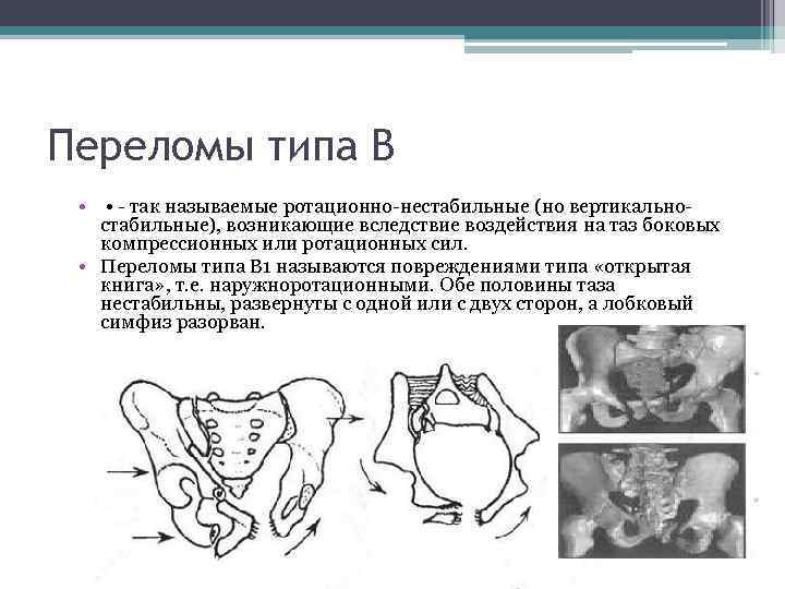 Перелом таза симптомы