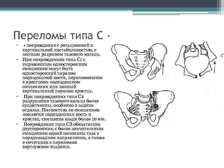 Перелом таза лечение