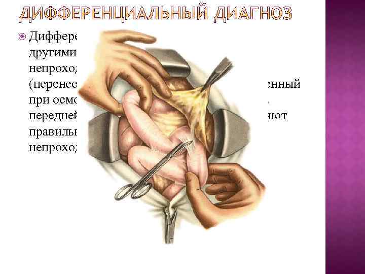  Дифференциальный диагноз проводят с другими видами острой кишечной непроходимости. Данные анамнеза (перенесенная лапаротомия)