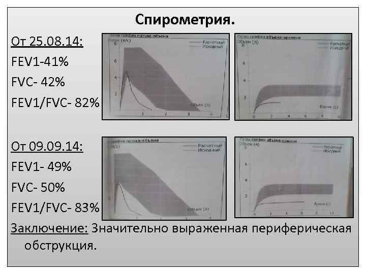 Спирометрия. От 25. 08. 14: FEV 1 -41% FVC- 42% FEV 1/FVC- 82% От