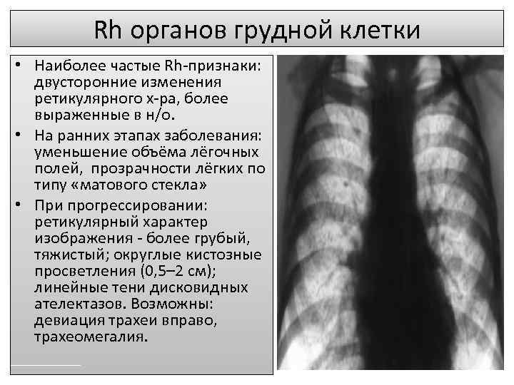 Rh органов грудной клетки • Наиболее частые Rh-признаки: двусторонние изменения ретикулярного х-ра, более выраженные