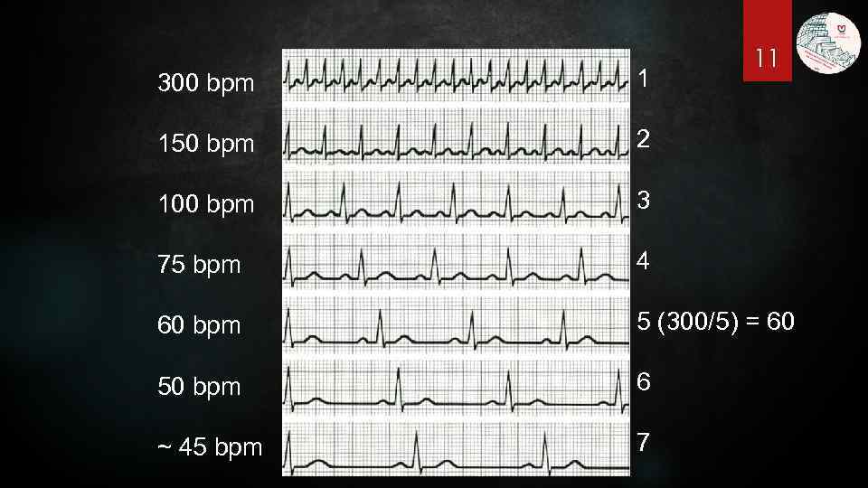11 300 bpm 1 150 bpm 2 100 bpm 3 75 bpm 4 60