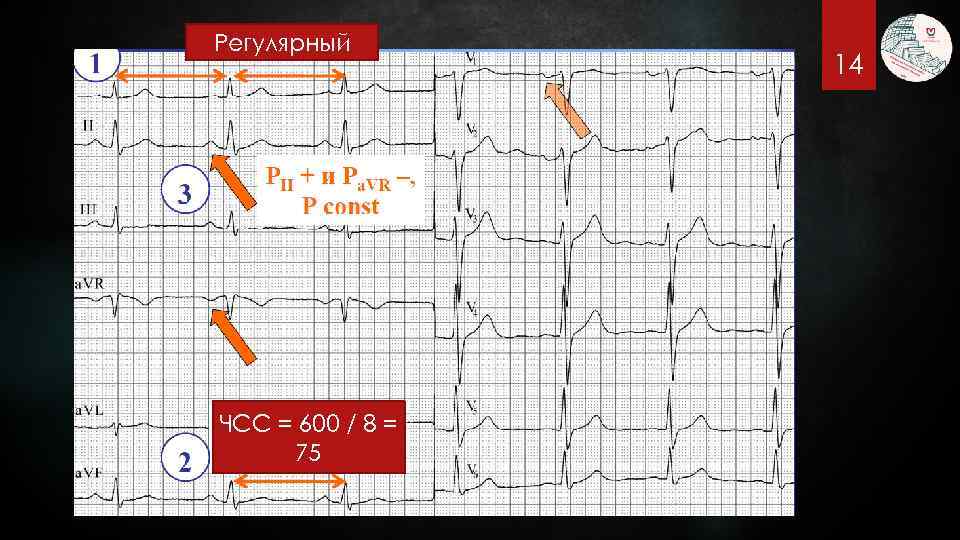 Регулярный ЧСС = 600 / 8 = 75 14 
