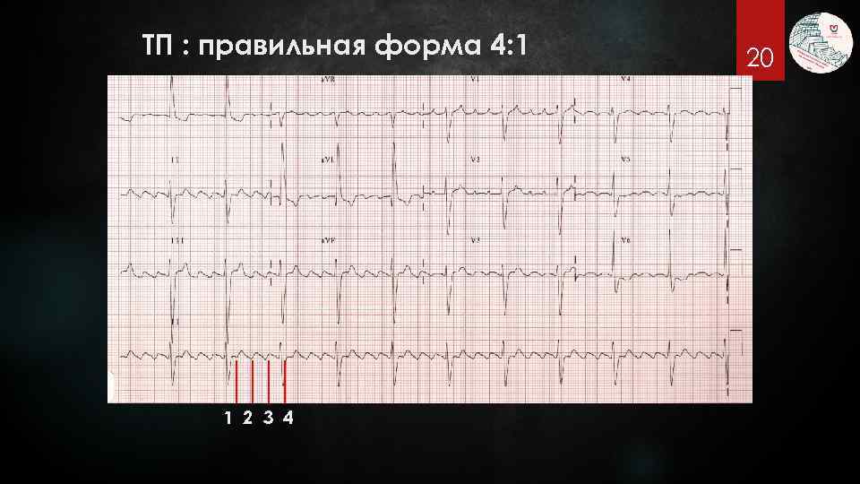 ТП : правильная форма 4: 1 1 2 3 4 20 