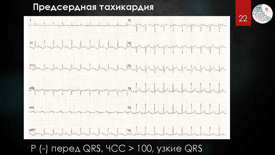 Предсердная тахикардия 22 P (-) перед QRS, ЧСС > 100, узкие QRS 