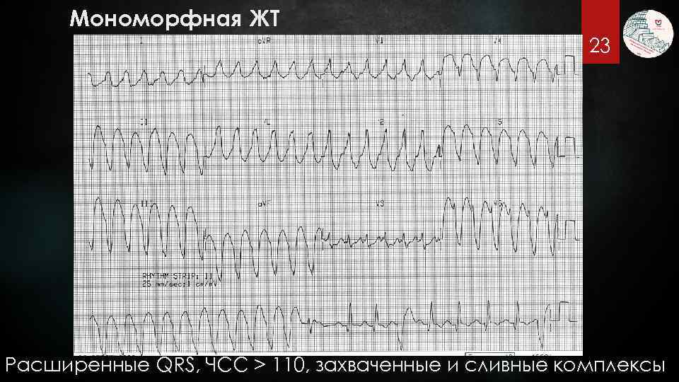 Мономорфная ЖТ 23 Расширенные QRS, ЧСС > 110, захваченные и сливные комплексы 