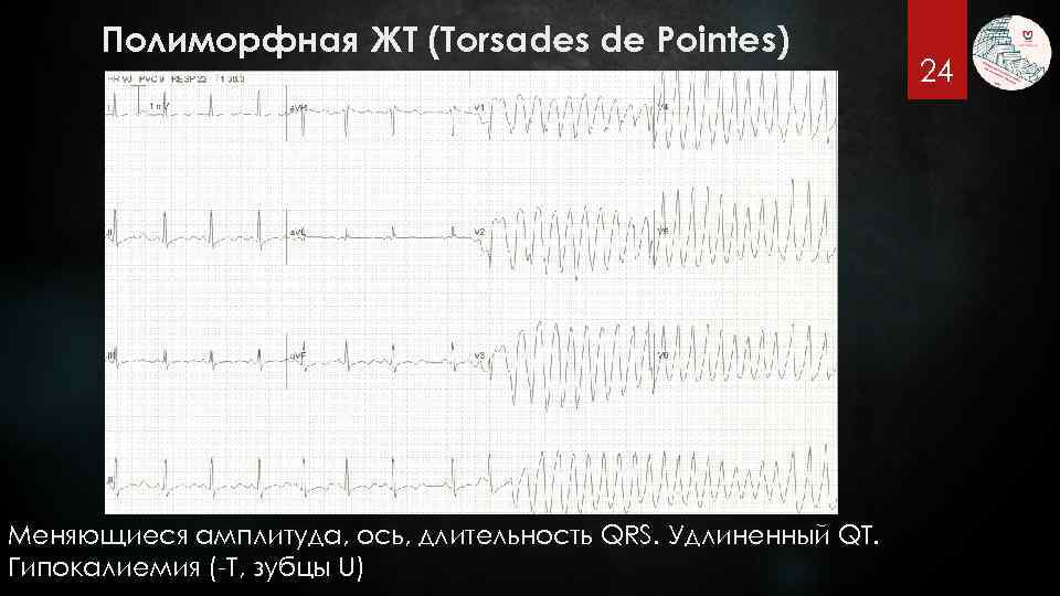 Полиморфная ЖТ (Torsades de Pointes) Меняющиеся амплитуда, ось, длительность QRS. Удлиненный QT. Гипокалиемия (-T,