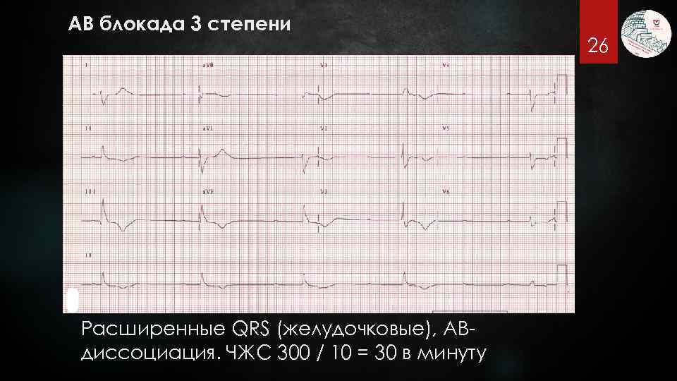 АВ блокада 3 степени Расширенные QRS (желудочковые), АВдиссоциация. ЧЖС 300 / 10 = 30