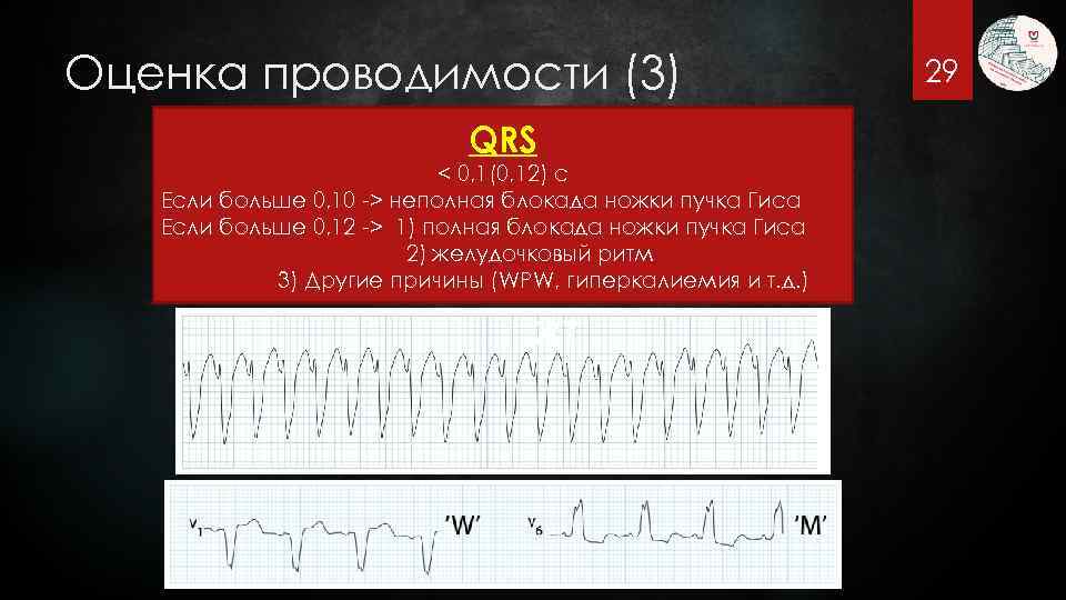 Оценка проводимости (3) QRS < 0, 1(0, 12) с Если больше 0, 10 ->