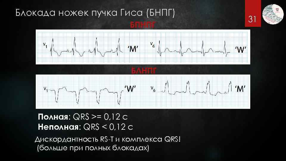 Блокада ножек пучка Гиса (БНПГ) БПНПГ БЛНПГ Полная: QRS >= 0, 12 с Неполная: