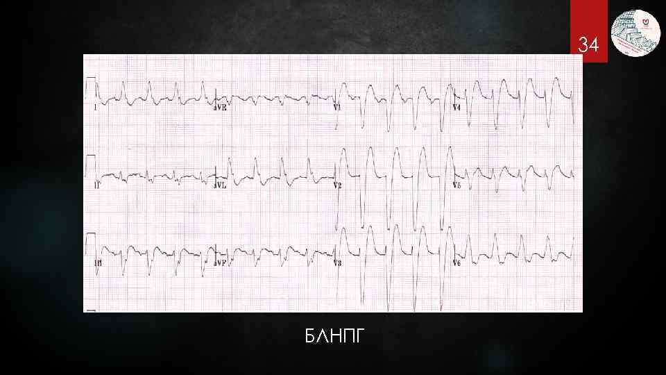 34 БЛНПГ 
