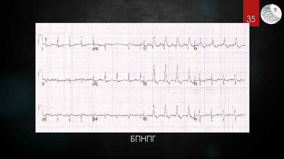 35 БПНПГ 