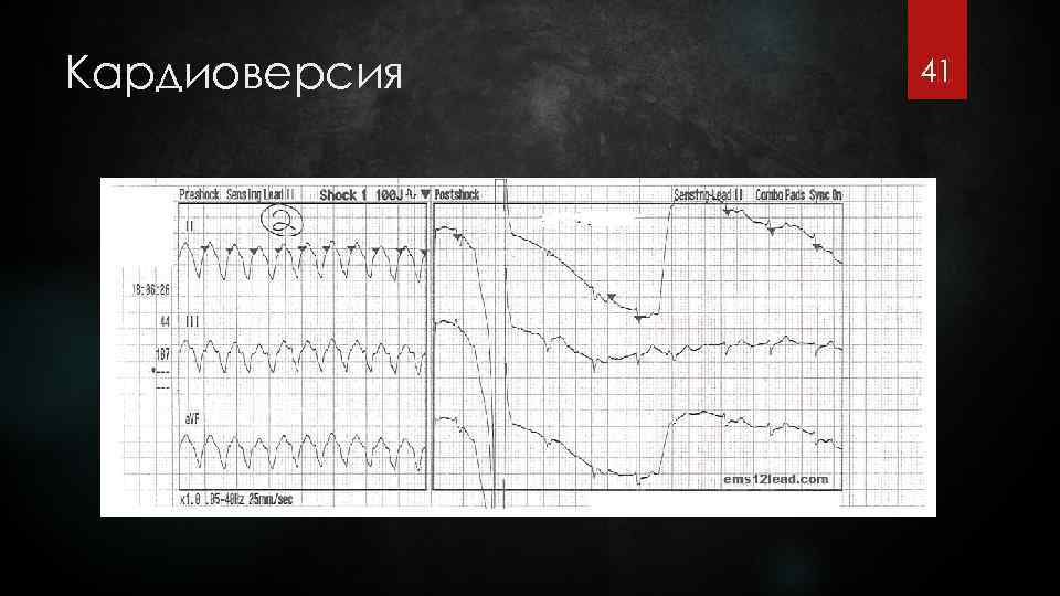 Кардиоверсия 41 