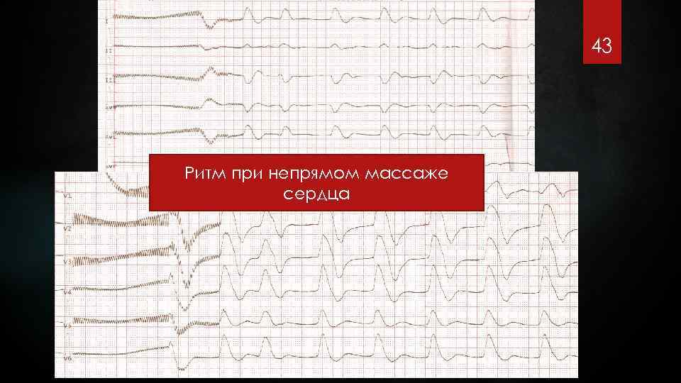 43 Ритм при непрямом массаже сердца 