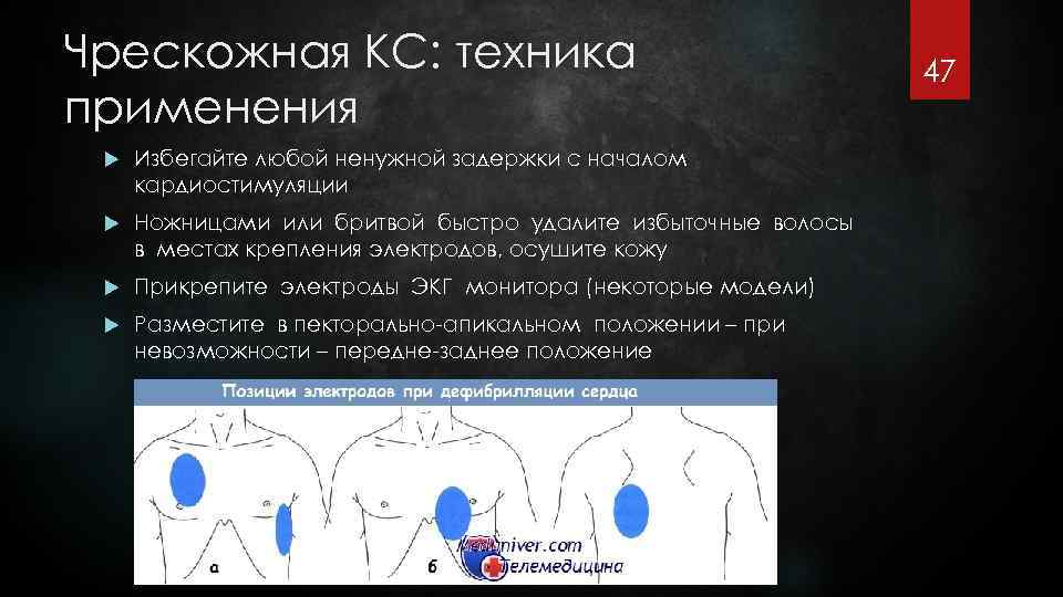Чрескожная КС: техника применения Избегайте любой ненужной задержки с началом кардиостимуляции Ножницами или бритвой