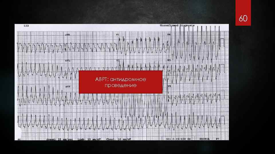 60 АВРТ: антидромное проведение 