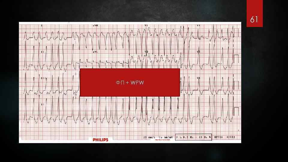 61 ФП + WPW 