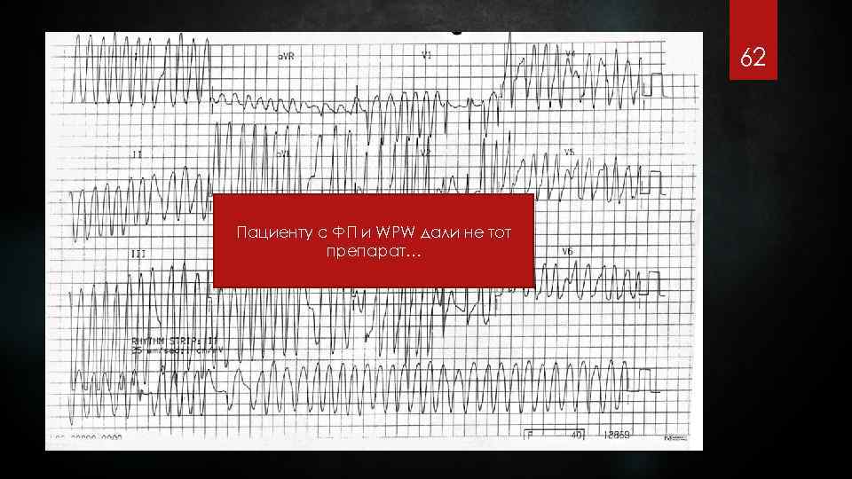 62 Пациенту с ФП и WPW дали не тот препарат… 