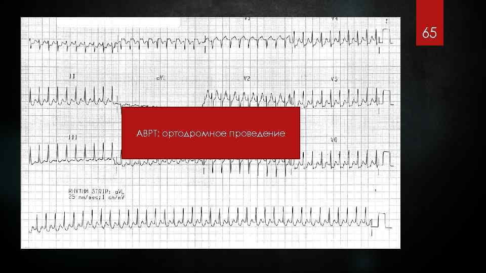 65 АВРТ: ортодромное проведение 