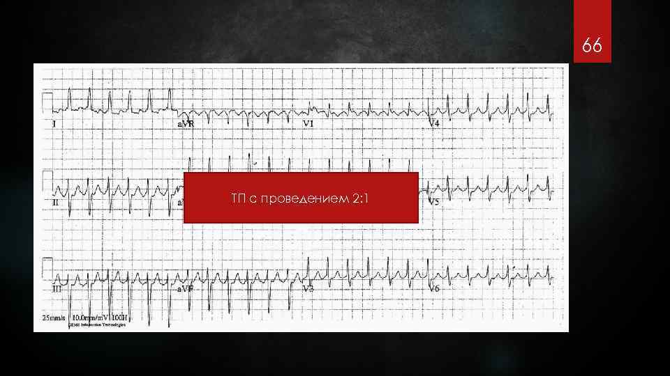 66 ТП с проведением 2: 1 