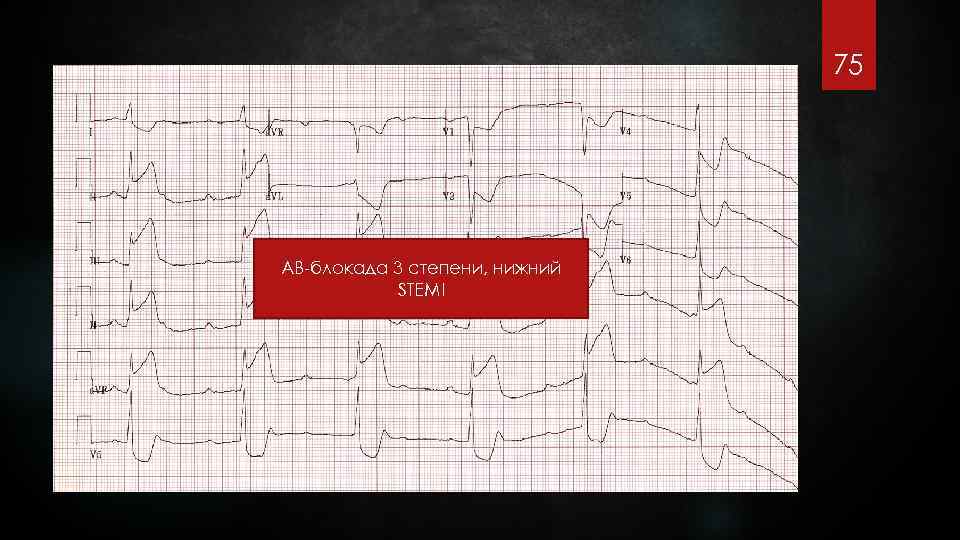75 АВ-блокада 3 степени, нижний STEMI 