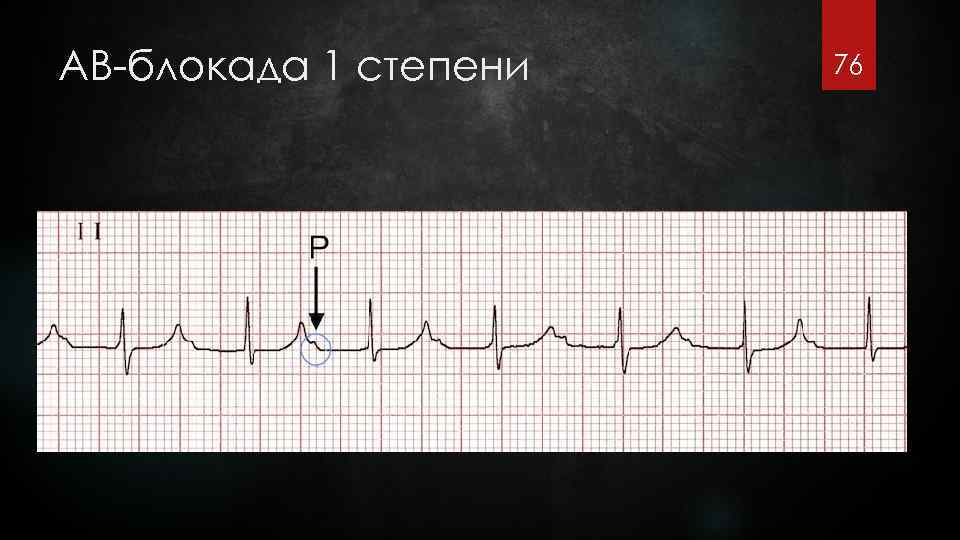 Ав блокады на экг картинки