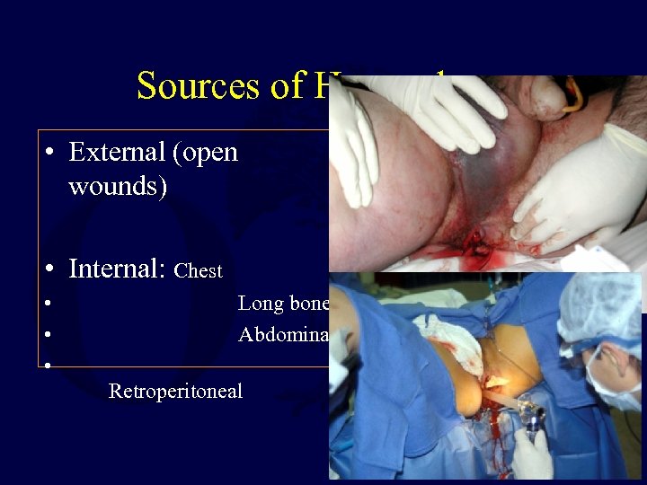 Sources of Hemorrhage • External (open wounds) • Internal: Chest • • • Long