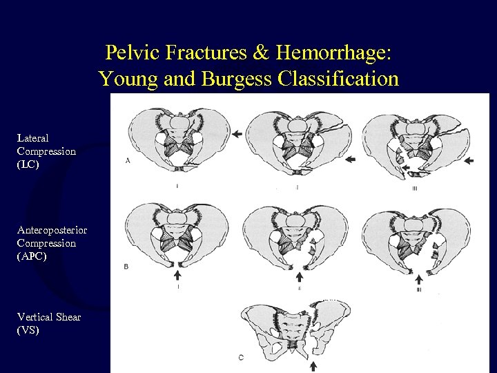 Pelvic Fractures & Hemorrhage: Young and Burgess Classification Lateral Compression (LC) Anteroposterior Compression (APC)