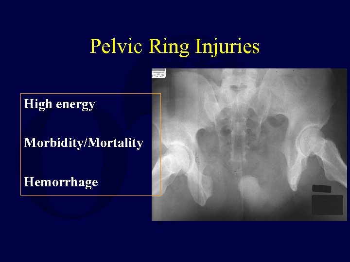 Pelvic Ring Injuries High energy Morbidity/Mortality Hemorrhage 