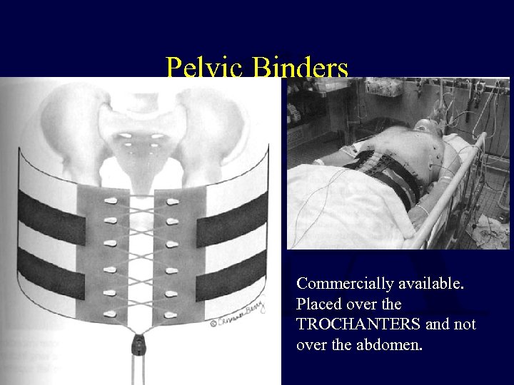 Pelvic Binders Commercially available. Placed over the TROCHANTERS and not over the abdomen. 