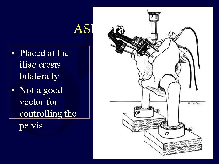 ASIS Frames • Placed at the iliac crests bilaterally • Not a good vector