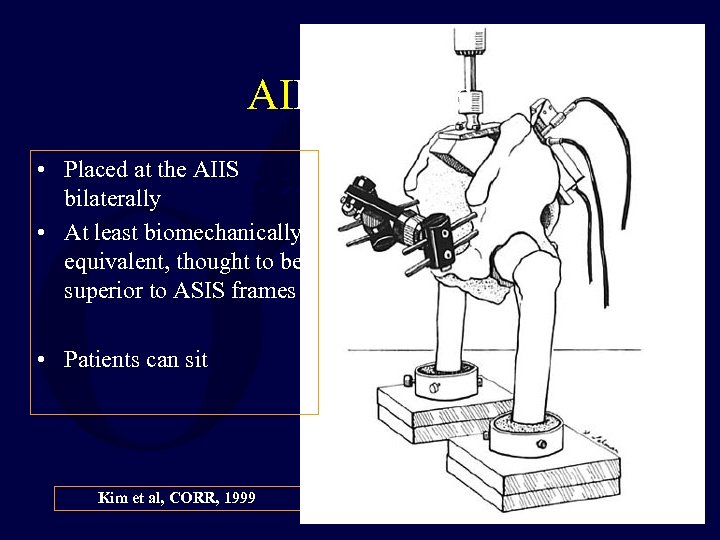 AIIS Frames • Placed at the AIIS bilaterally • At least biomechanically equivalent, thought