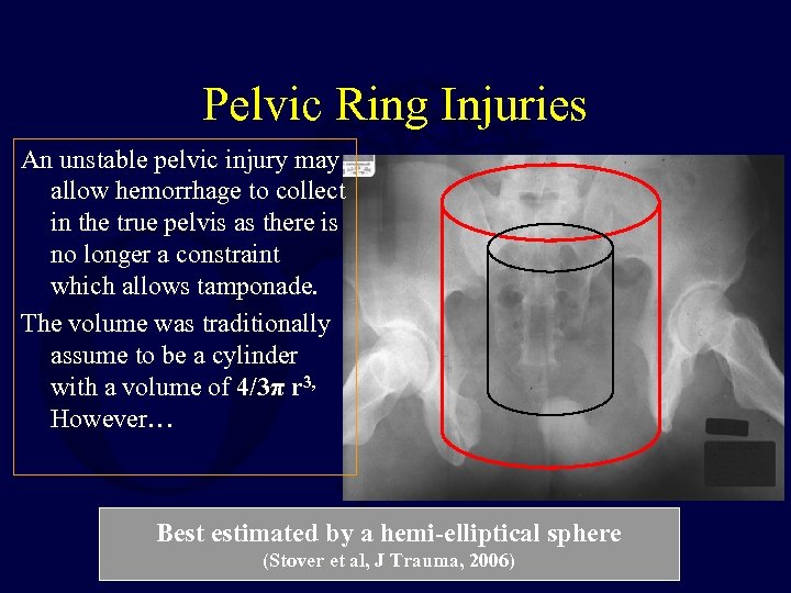 Pelvic Ring Injuries An unstable pelvic injury may allow hemorrhage to collect in the