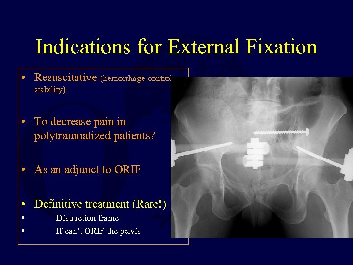 Indications for External Fixation • Resuscitative (hemorrhage control, stability) • To decrease pain in